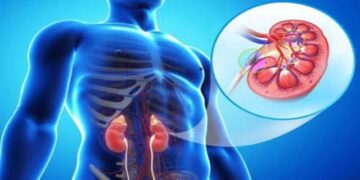 কিডনির এক নীরব ঘাতক হাইড্রোনেফ্রোসিস