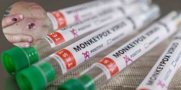 মাঙ্কিপক্স নিয়ে ‘ভয় নেই’ বাংলাদেশের !