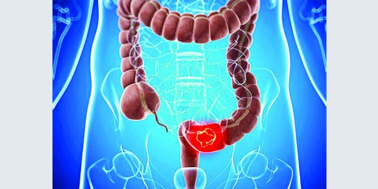 পায়ুপথের ক্যানসার