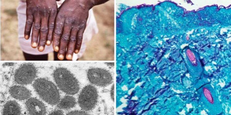 বিশ্বজুড়ে মাংকিপক্সে শনাক্ত ৭০০ ছাড়িয়েছে: সিডিসি