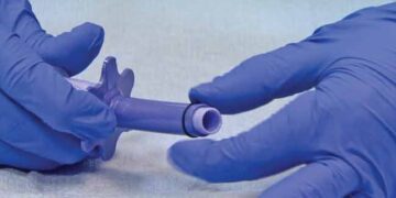 রিং লাইগেশনে পাইলসের চিকিৎসা