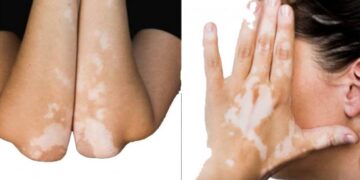 শ্বেতির চিকিৎসা নিয়ে কথা