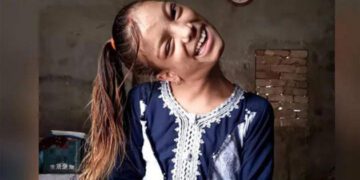সেই শিশুর ঘাড়ের ‘বোঝা’ হালকা করলেন চিকিৎসক !