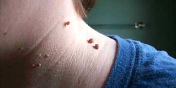 আঁচিল নিয়ে কিছু কথা