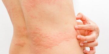 সব চুলকানিই কী চর্মরোগ?