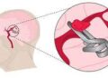 ব্রেইন অ্যানিউরিজম ক্লিপিং: ব্রেইন-এর একটি চ্যালেঞ্জিং অপারেশন