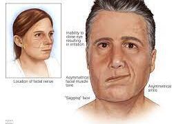 মুখের প্যারালাইসিসের উপসর্গ, কী করবেন