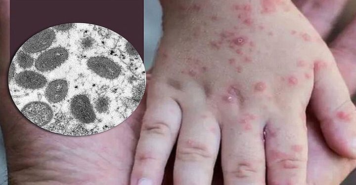 কানাডায় ৬০৪ জন মাঙ্কিপক্সের রোগী শনাক্ত