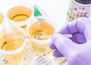 প্রশ্রাবের সাথে প্রোটিন বের হওয়া  বা প্রোটিনিউরিয়া কেন হয় জানেন? (পর্ব- ১)