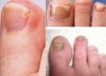 যন্ত্রণাদায়ক নখকুনি থেকে বাঁচতে জেনে নিন করণীয়