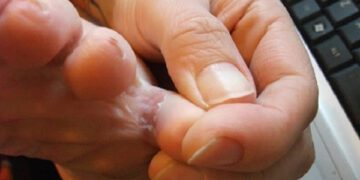 পায়ের আঙুলের ফাঁকে ঘা হওয়ার কারণ ও করণীয়