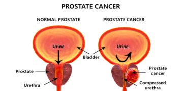 প্রোস্টেট ক্যান্সারের লক্ষণ ও চিকিৎসা