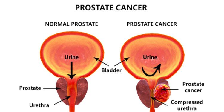 প্রোস্টেট ক্যান্সারের লক্ষণ ও চিকিৎসা