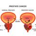 প্রোস্টেট ক্যান্সারের লক্ষণ ও চিকিৎসা