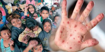 নতুন আতংক, শিশুদের টমেটো ফ্লু !