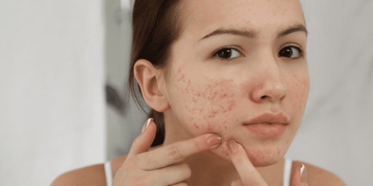 ব্রণের সমস্যা বাড়তে পারে যে কারণে