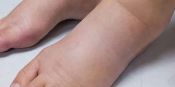 ইডিমা কী ? করণীয় জেনে নিন