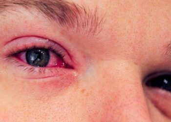 চোখ ওঠা রোগ