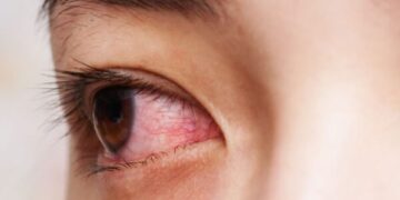 হঠাৎ চোখ উঠা বা কনজাংটিভাইটিস হলে কি করবেন?