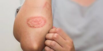 খোসপাঁচড়া রোগের লক্ষণ, প্রতিকার ও চিকিৎসা