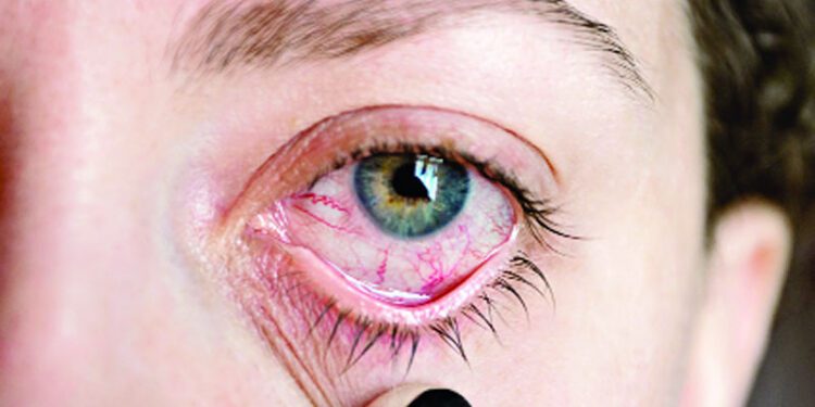 চোখের রোগ ইউভাইটিস হলে করণীয়