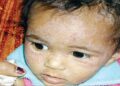 বাচ্চাদের এটোপিক ডার্মাটাইটিস