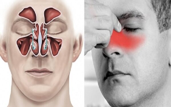 ঘরোয়া ভাবে সাইনাসের ব্যথা দূর করার উপায়