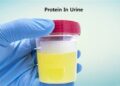 প্রশ্রাবের সাথে প্রোটিন বের হওয়া বা প্রোটিনিউরিয়া কেন হয় জানেন? ( পর্ব-২)