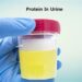 প্রশ্রাবের সাথে প্রোটিন বের হওয়া বা প্রোটিনিউরিয়া কেন হয় জানেন? ( পর্ব-২)