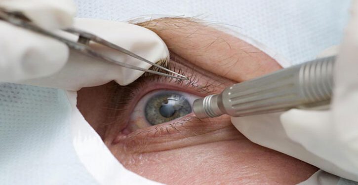 দেশে ৮০ শতাংশ দৃষ্টিপ্রতিবন্ধির মূল কারণ ছানি
