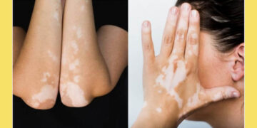 শ্বেতী রোগের কারণ, লক্ষণ ও চিকিৎসা