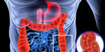 আলসারেটিভ কোলাইটিসের ব্যথা ও চিকিৎসা