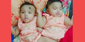 দেশে প্রথমবার জোড়া মেরুদণ্ডের দুই শিশুকে আলাদা করবে বিএসএমএমইউ