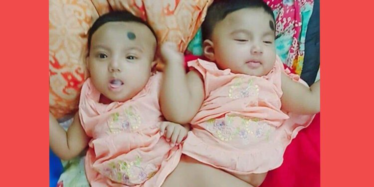 দেশে প্রথমবার জোড়া মেরুদণ্ডের দুই শিশুকে আলাদা করবে বিএসএমএমইউ