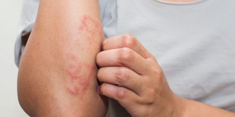 শীতের চর্মরোগে যা করবেন