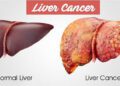 শারীরিক কিছু পরিবর্তনে বুঝা যাবে লিভার ক্যান্সারের উপস্থিতি