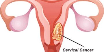 ক্যান্সারে জরায়ু না ফেলেই মৃত্যুঝুঁকি এড়ান