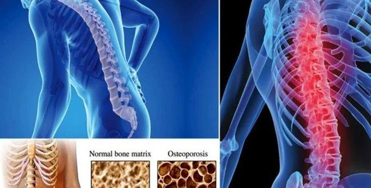 হাড়ক্ষয় বা অস্টিওপোরেসিস রোধে যা খাবেন ,যেসব খাবার বাদ দিবেন